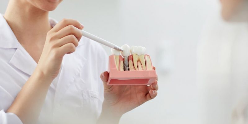 How Dental Implants Can Add To Your Oral Health