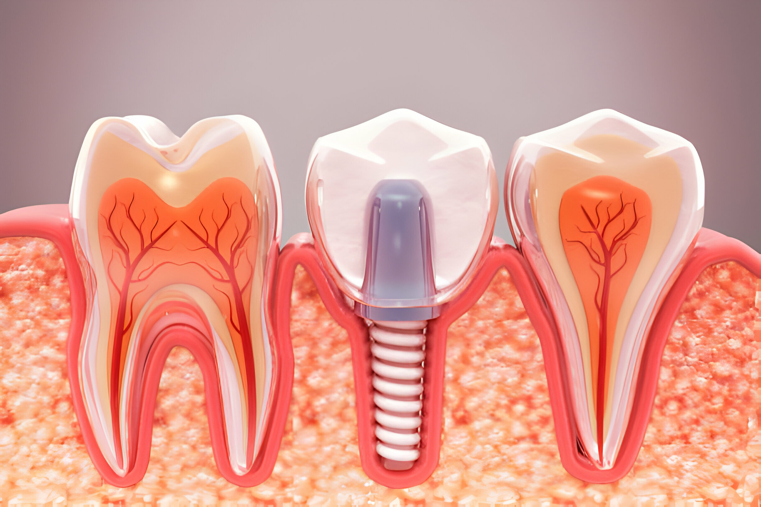 What to Expect During Dental Implants in Frisco, TX_1
