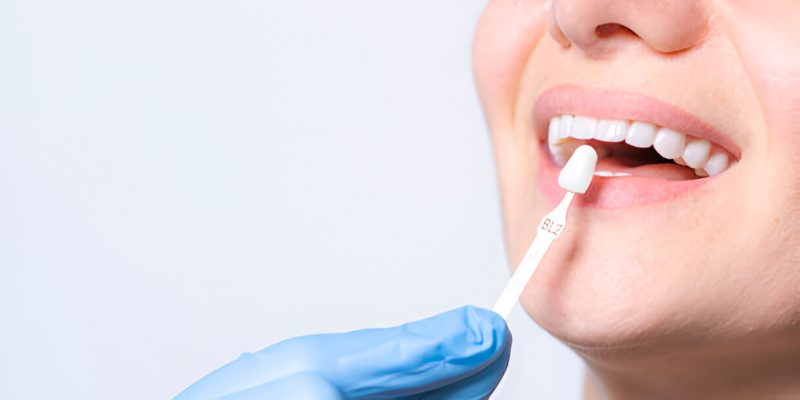 What to Expect During Your Veneers Consultation in Frisco