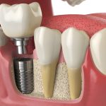 What to Expect During the Recovery Process After Dental Implants in Frisco, TX_FI