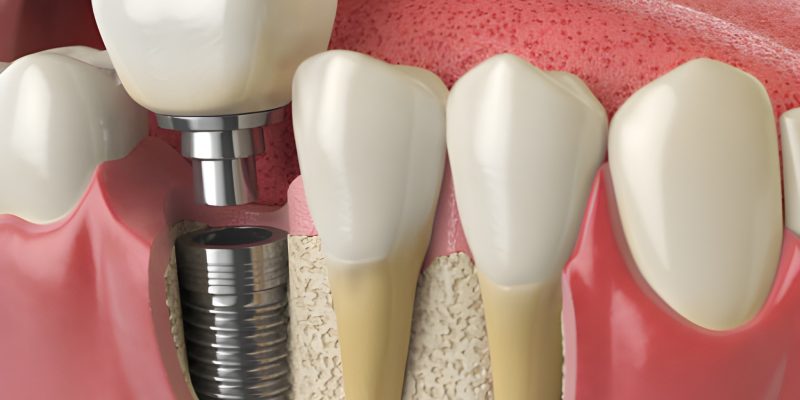 What to Expect During the Recovery Process After Dental Implants in Frisco, TX_FI