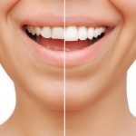 Smile Makeovers with Porcelain Veneers: A Complete Guide for Frisco Patients_FI
