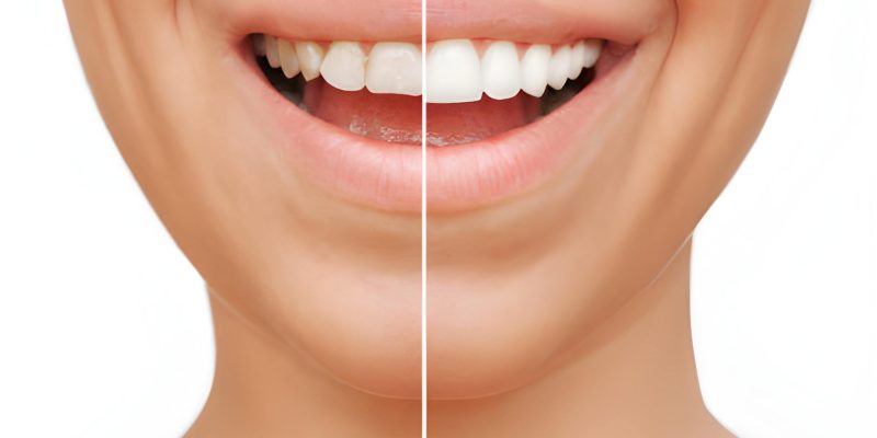 Smile Makeovers with Porcelain Veneers: A Complete Guide for Frisco Patients_FI