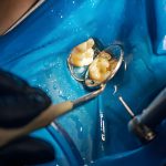 How Dental Arts of Frisco Makes Tooth Extractions Comfortable and Stress-Free_FI
